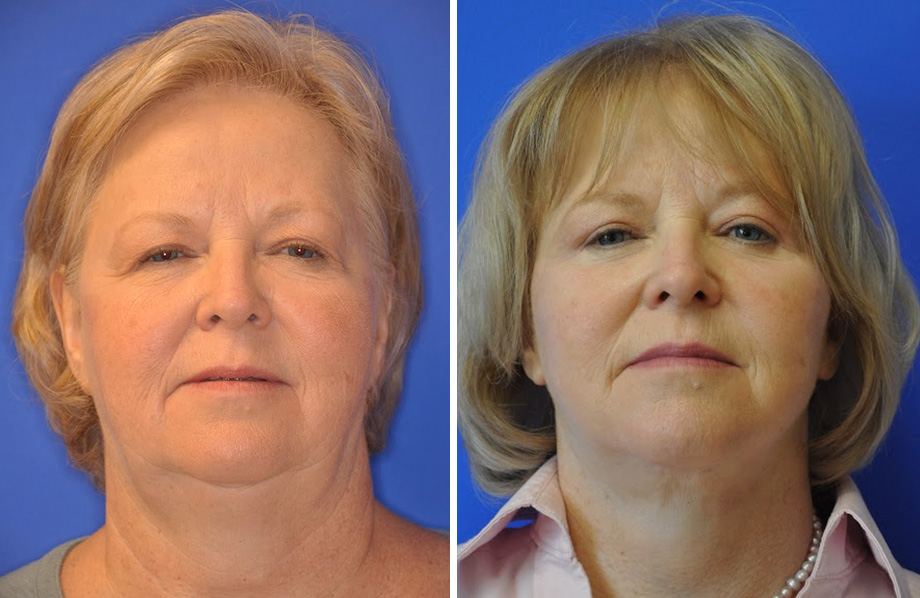 Facelift Austin TX Dr Weinfeld