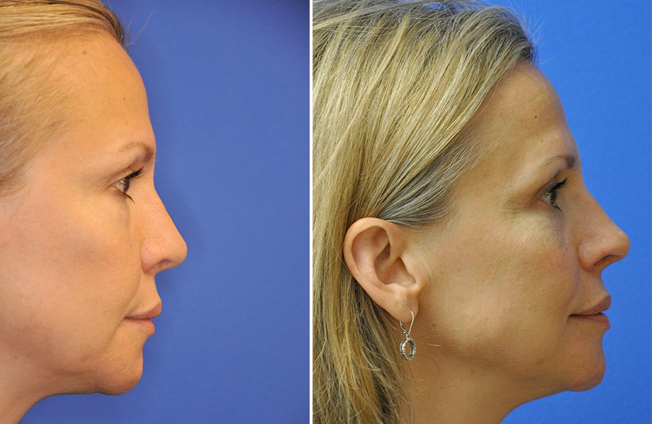 Revision Rhinoplasty 4 Austin TX Dr Weinfeld