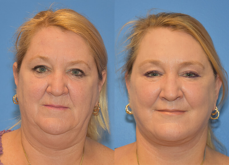 Facelift Neck Lift Archives Page Of Adam Bryce Weinfeld Md