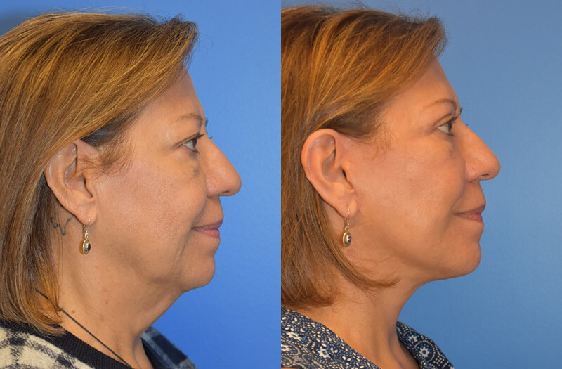 Facelift And Neck Lift Austin Tx Dr Weinfeld