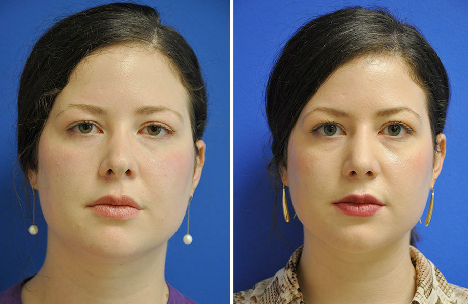 Revision Rhinoplasty Austin Tx Dr Weinfeld