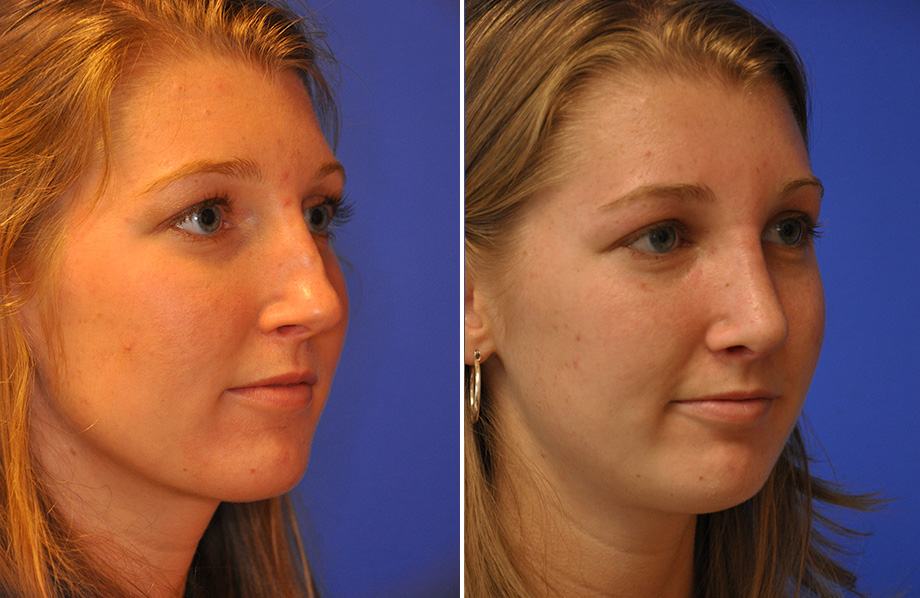 Revision Rhinoplasty Austin Tx Dr Weinfeld