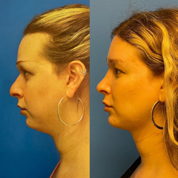 Facial Feminization Before And After - Adam Bryce Weinfeld, MD, Board ...