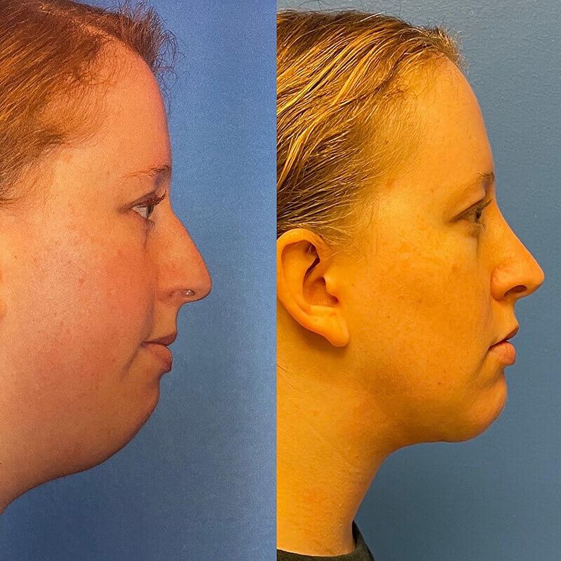 Neck Contouring Archives - Adam Bryce Weinfeld, MD, Board-Certified ...