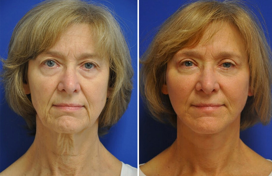 Facelift & Neck Lift Archives - Adam Bryce Weinfeld, MD, Board ...