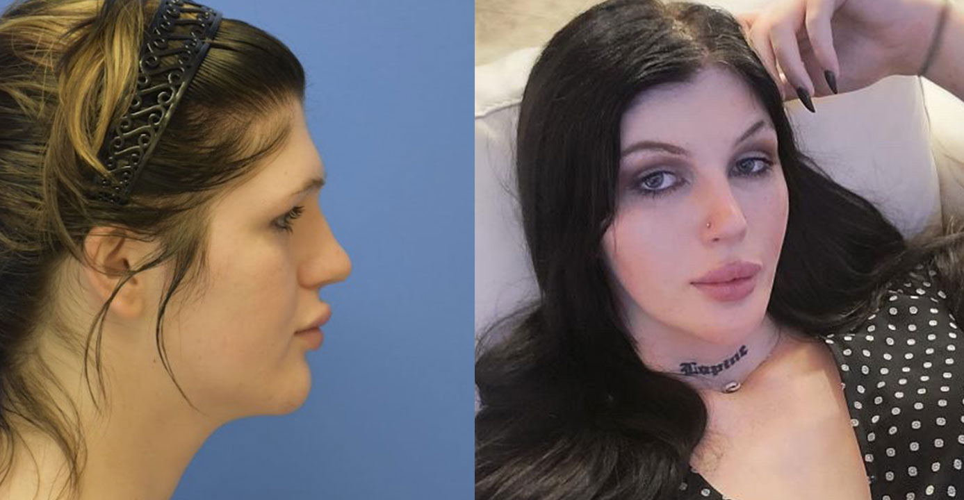 Facial Feminization Before And After Adam Bryce Weinfeld Md Board Certified Plastic Surgeon